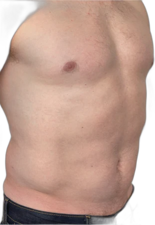 Before: Everesse skin tightening on the abdomen