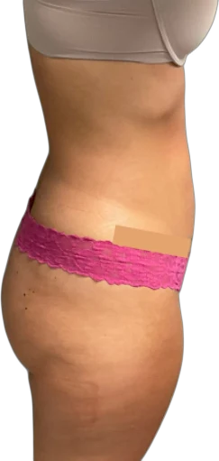After: Everesse skin tightening on the abdomen and flank