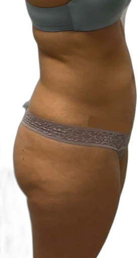 Before: Everesse skin tightening on the abdomen and flank