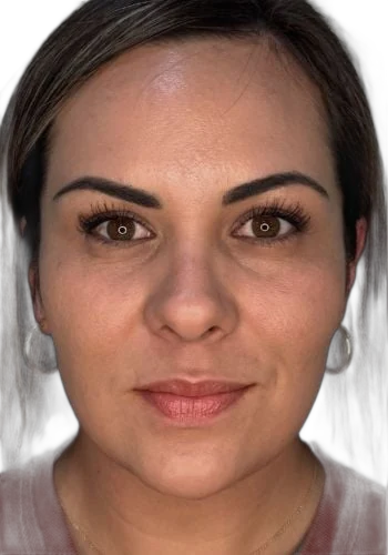 After: Everesse skin tightening on the face