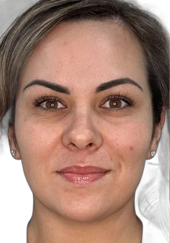 Before: Everesse skin tightening on the face