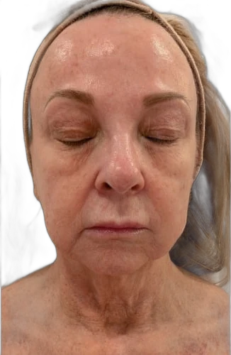 After: Everesse skin tightening on the face and neck