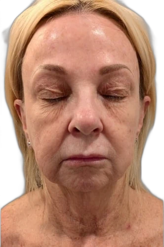 Before: Everesse skin tightening on the face and neck