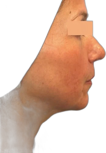 Everesse Skin Tightening