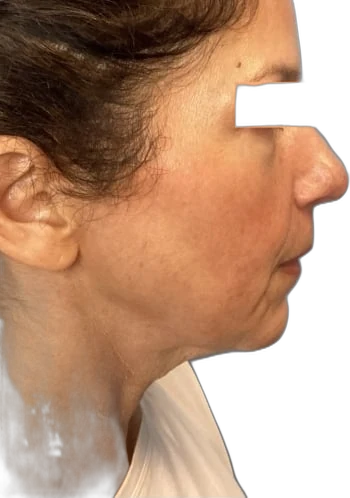 Before: Everesse skin tightening on the jawline