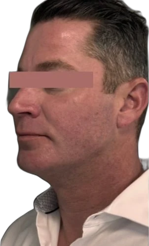 After: Everesse skin tightening on the jawline