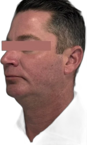 Before: Everesse skin tightening on the jawline