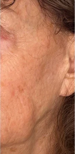 After: Everesse skin tightening on the neck