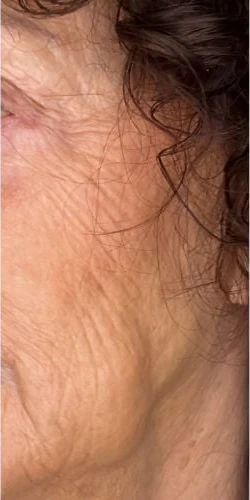 Before: Everesse skin tightening on the neck