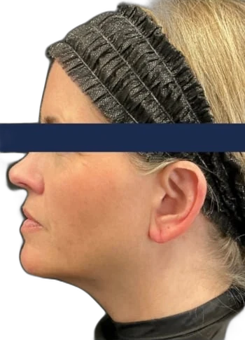 After: Everesse skin tightening on the neck and jawline
