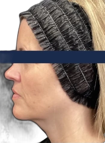 Before: Everesse skin tightening on the neck and jawline