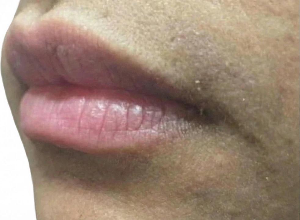 After: Laser hair removal on the upper lip
