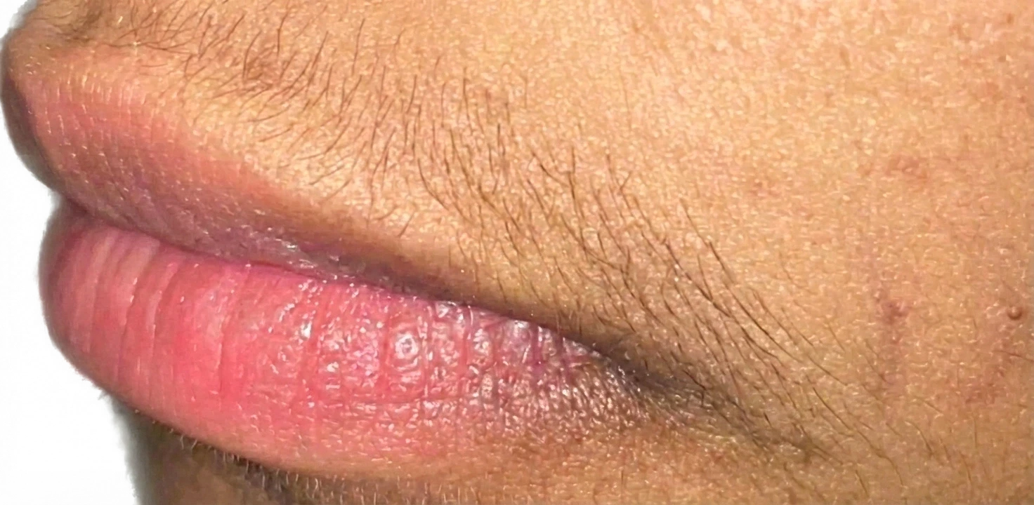 Before: Laser hair removal on the upper lip