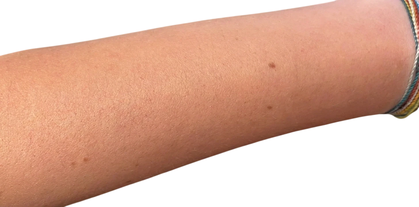Laser Hair Removal