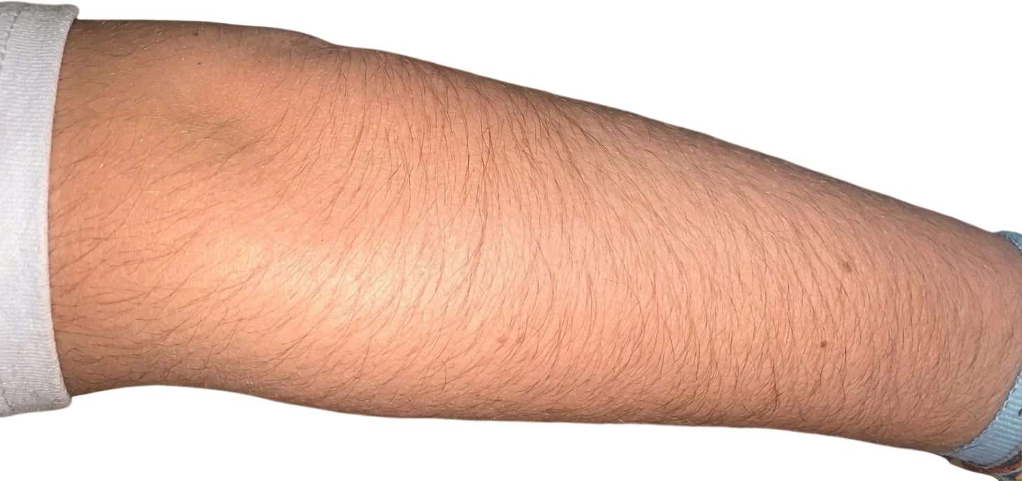 Before: Laser hair removal on the forearm