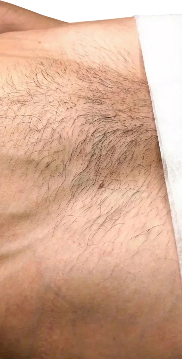 Before: Laser hair removal on the underarm