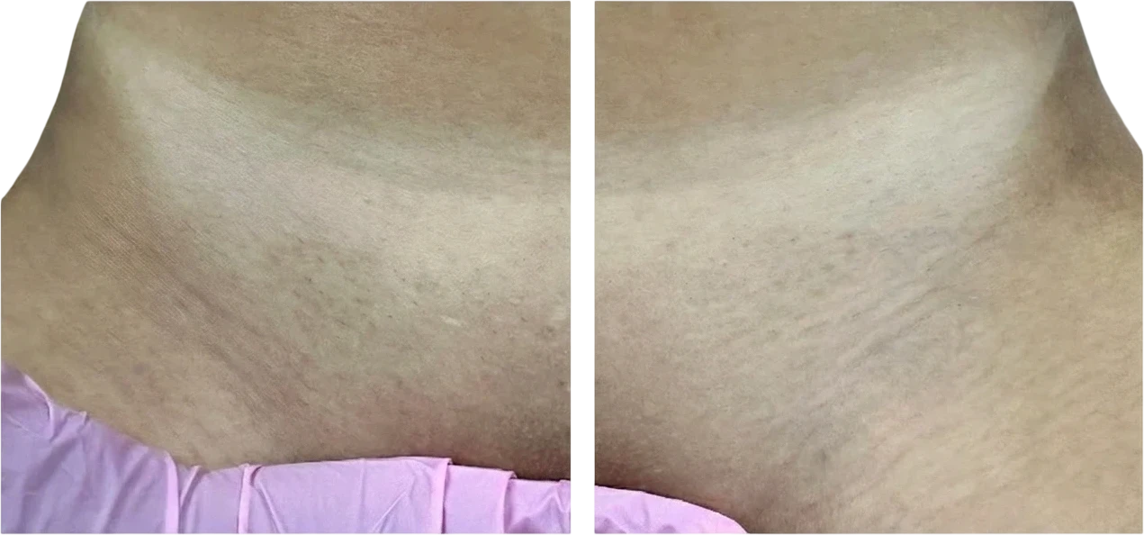 After: Laser hair removal on the bikini area