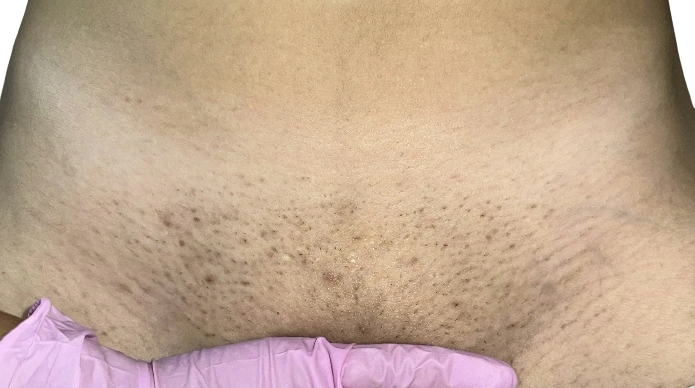 Before: Laser hair removal on the bikini area
