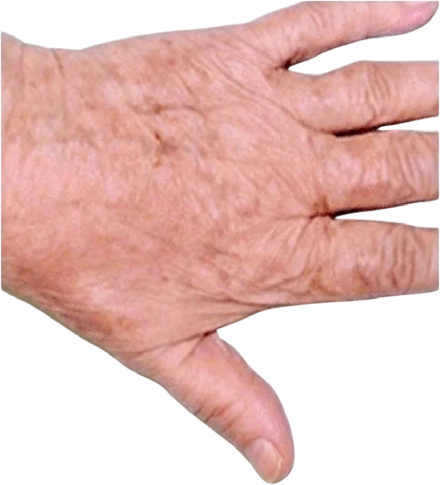 Sun Spot & Age Spot Removal