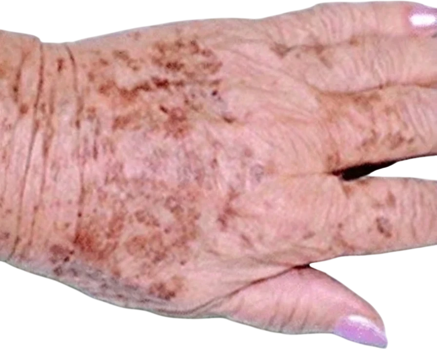 Before: Laser treatment of sun spots on the back of the hand