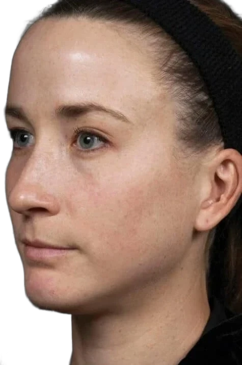 Laser Skin Revitalization