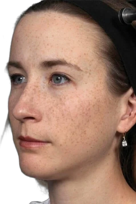 Before: Laser skin revitalization for tone and texture on the face