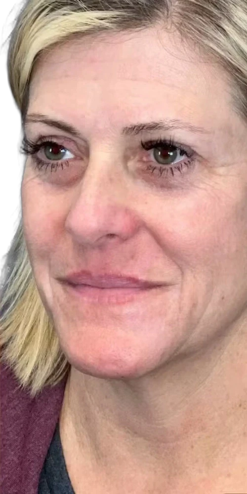 After: Laser skin revitalization for fine lines and tone on the face
