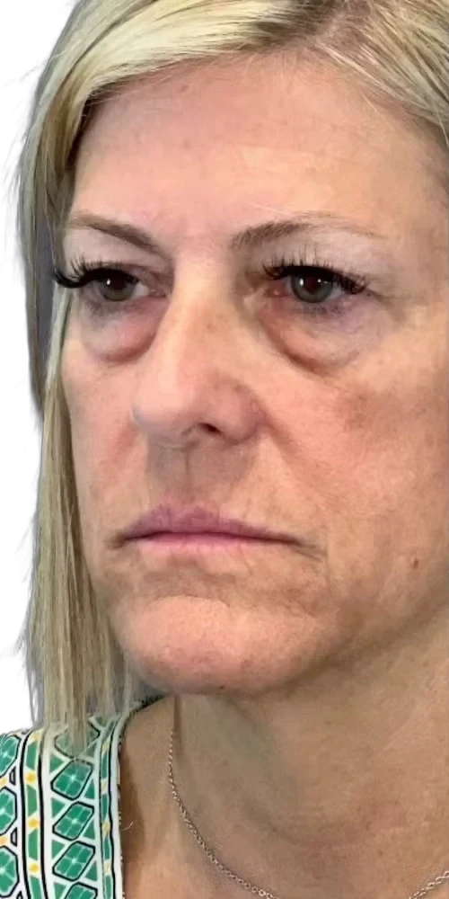 Before: Laser skin revitalization for fine lines and tone on the face