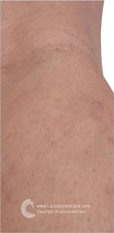 After: Laser treatment of spider veins on the leg