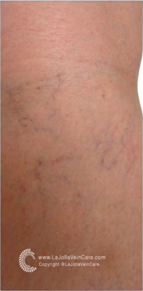 Before: Laser treatment of spider veins on the leg