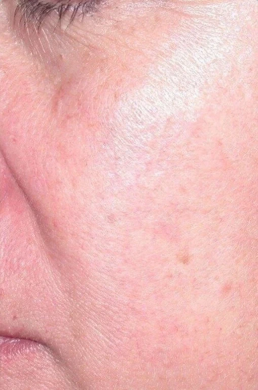 Spider Veins & Redness