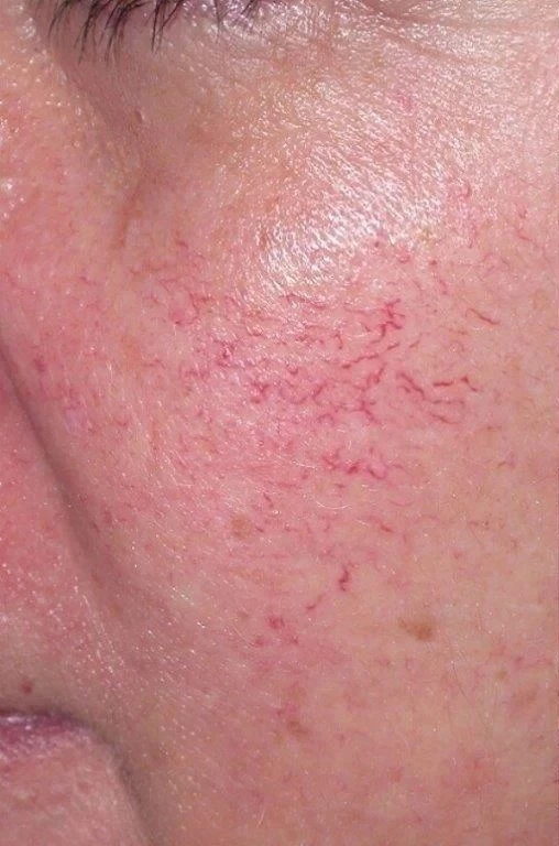Before: Laser treatment of redness and broken capillaries on the cheek